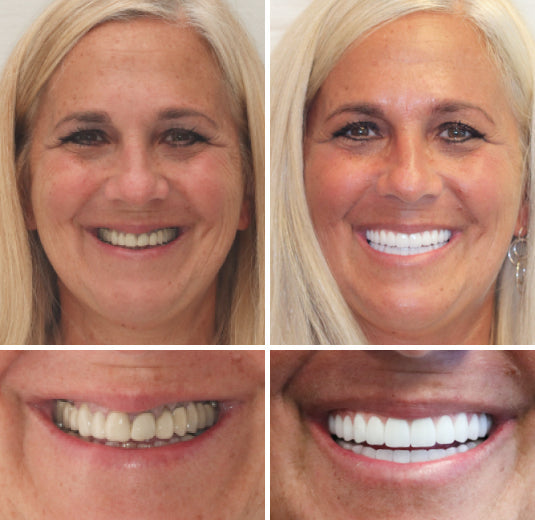 Natural Look Complete Dentures Set With Custom Fit For All Day Comfort And Confidence