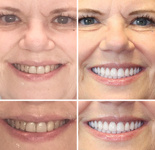 Natural Look Complete Dentures Set With Custom Fit For All Day Comfort And Confidence