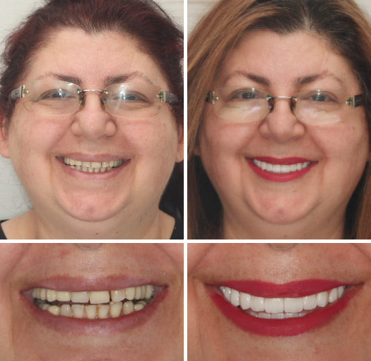 Natural Look Complete Dentures Set With Custom Fit For All Day Comfort And Confidence