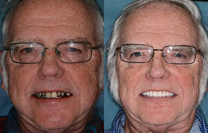 Natural Look Complete Dentures Set With Custom Fit For All Day Comfort And Confidence