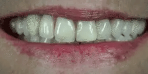 NovaBright Snap-On Veneers For Top And Bottom Teeth Custom Fit Removable Smile Solution