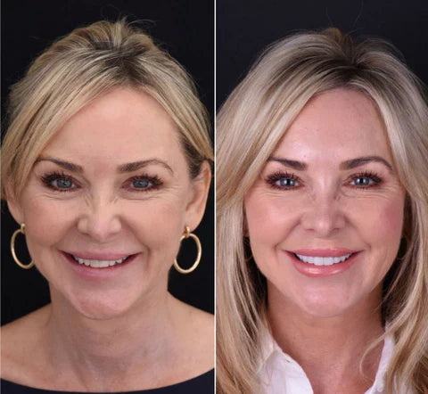 NovaBright Snap-On Veneers For Top And Bottom Teeth Custom Fit Removable Smile Solution
